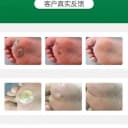 云南本草藏红花手足鸡眼茧精华液膏贴跖尤康净脚老茧脚垫肉刺瘊子 3